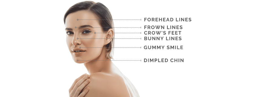 Botox Injection Areas For The Face