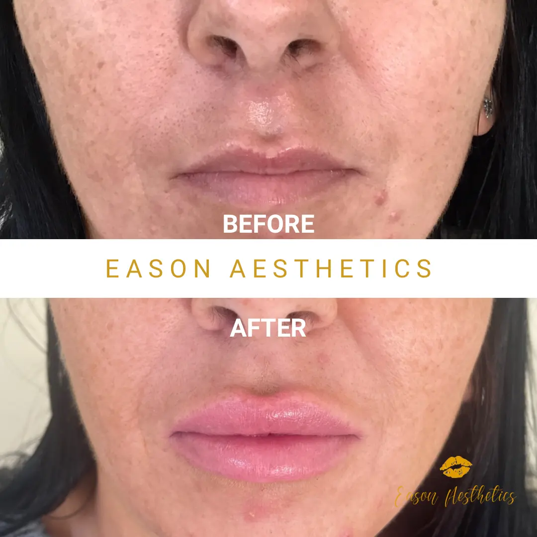 Lip Fillers Juvederm Before After